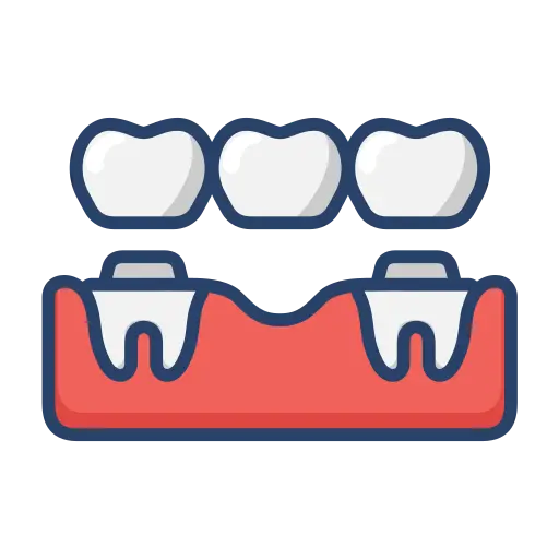 Dental Bridge