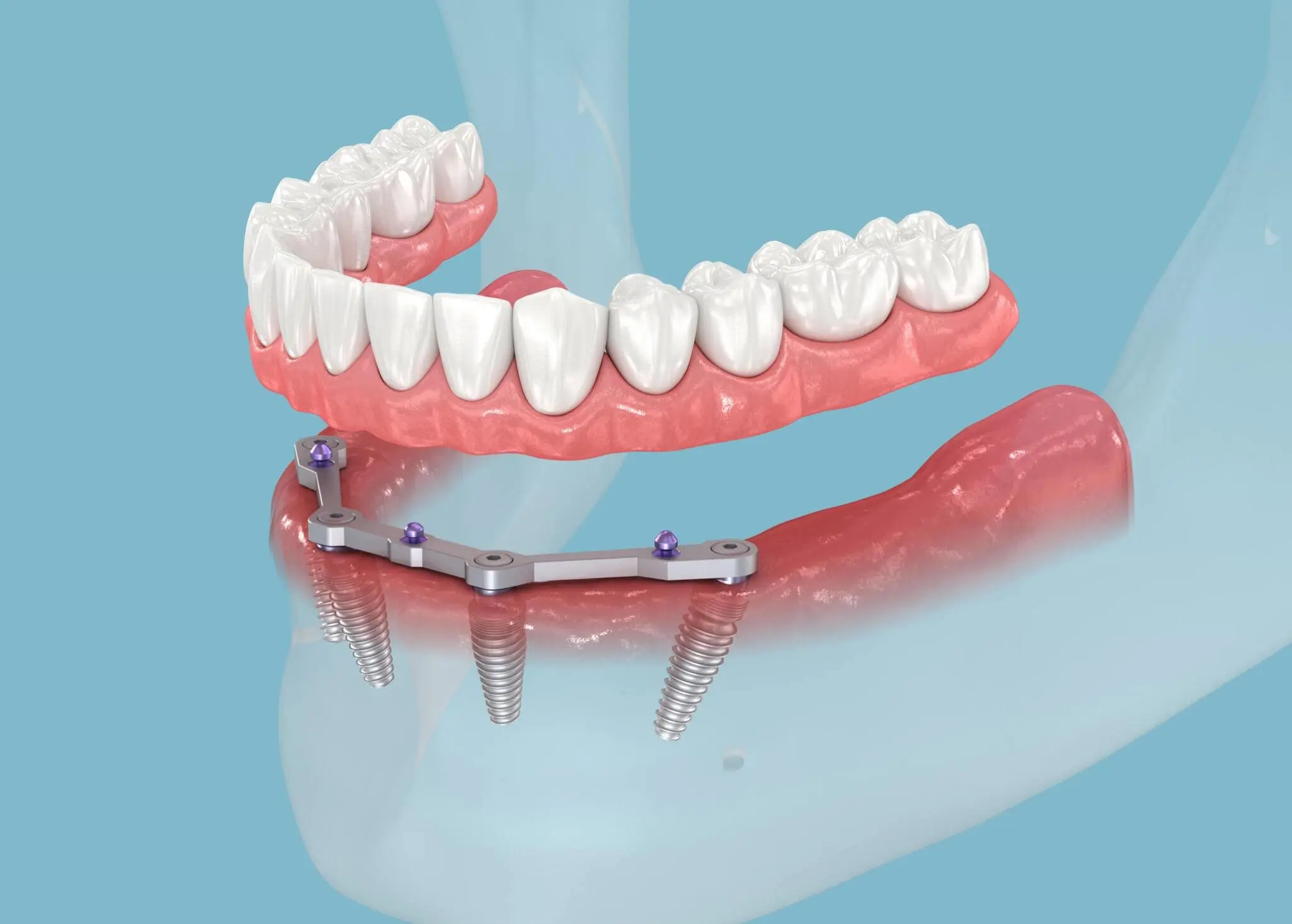 All-on-4 Implants